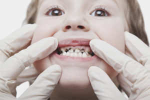  Placa negra en los dientes de un niño.