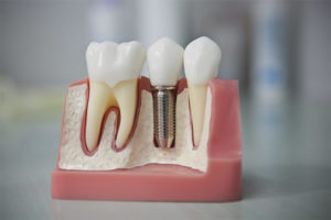  Implantacion dental